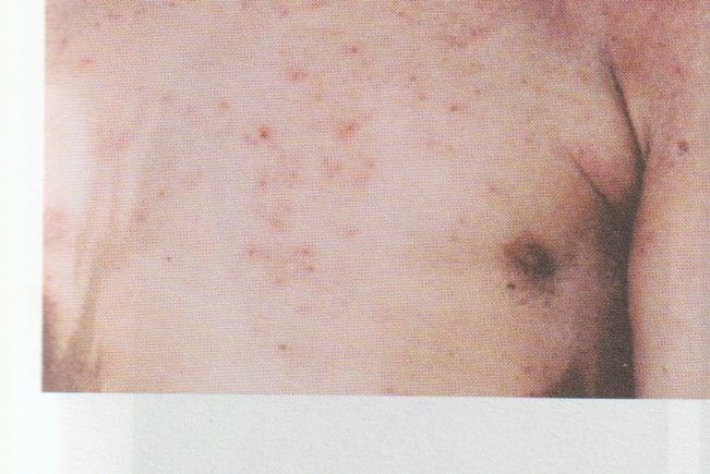 My Child Lived With Atopic Dermatitis for 3 Years: A Father’s Record of What Changed After 2 Weeks and 2 Months