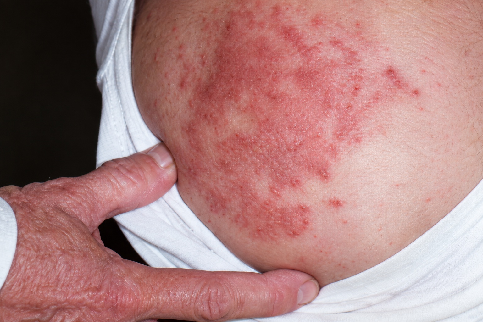 From Widespread Rash to Improved Skin After 3 Months