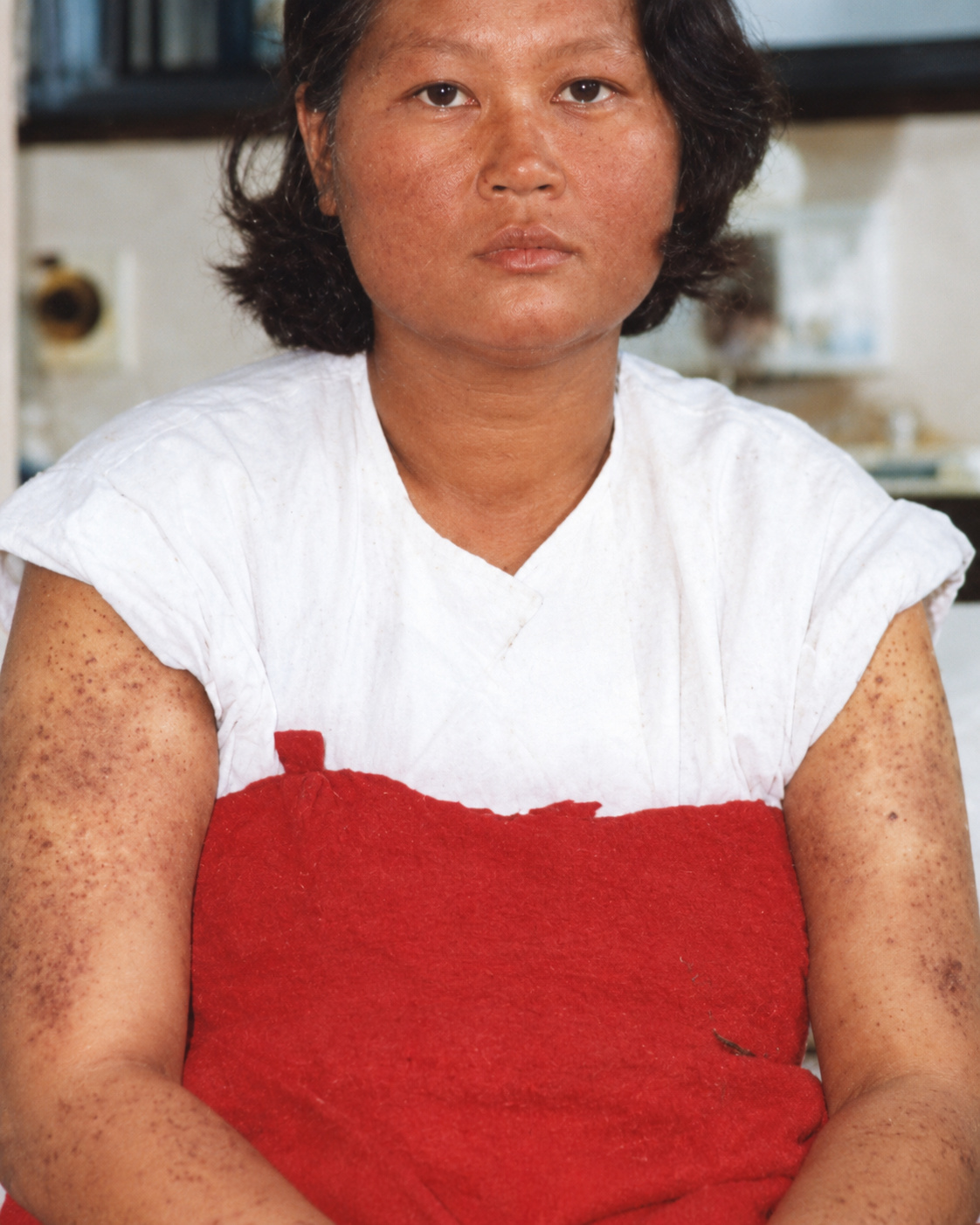 Before taking enzyme: Hui Yun’s appearance and the condition of her arms at the time.